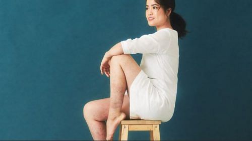 Psoriasis did not stop Yvonne Chan from being proud of the woman she is
