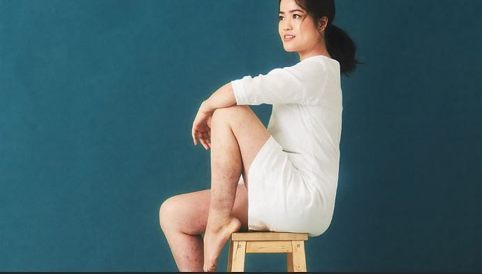 Psoriasis did not stop Yvonne Chan from being proud of the woman she is