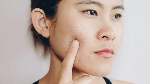 Skincare experts on dealing with adult acne