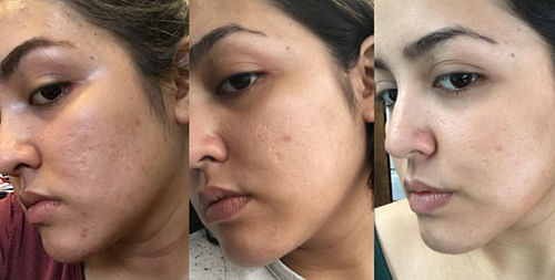 how to get rid of adult acne in two months - her world - singapore